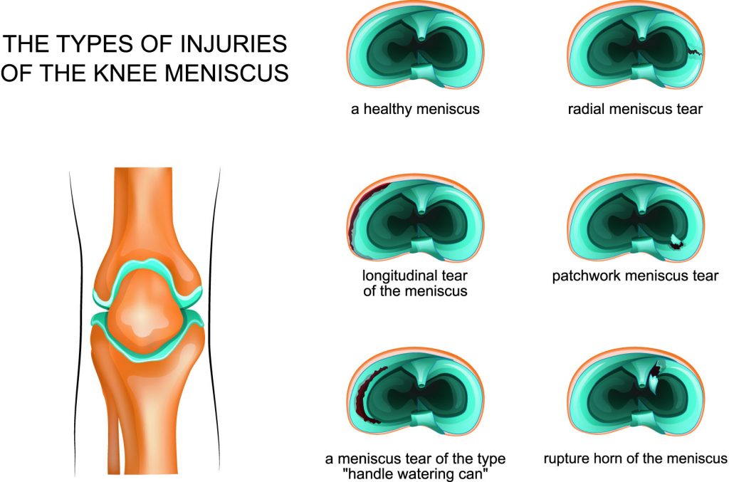 A meniscus tear after a car accident is a serious injury