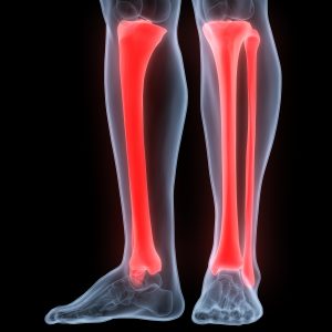 A tibia fracture after a car accident is a serious injury