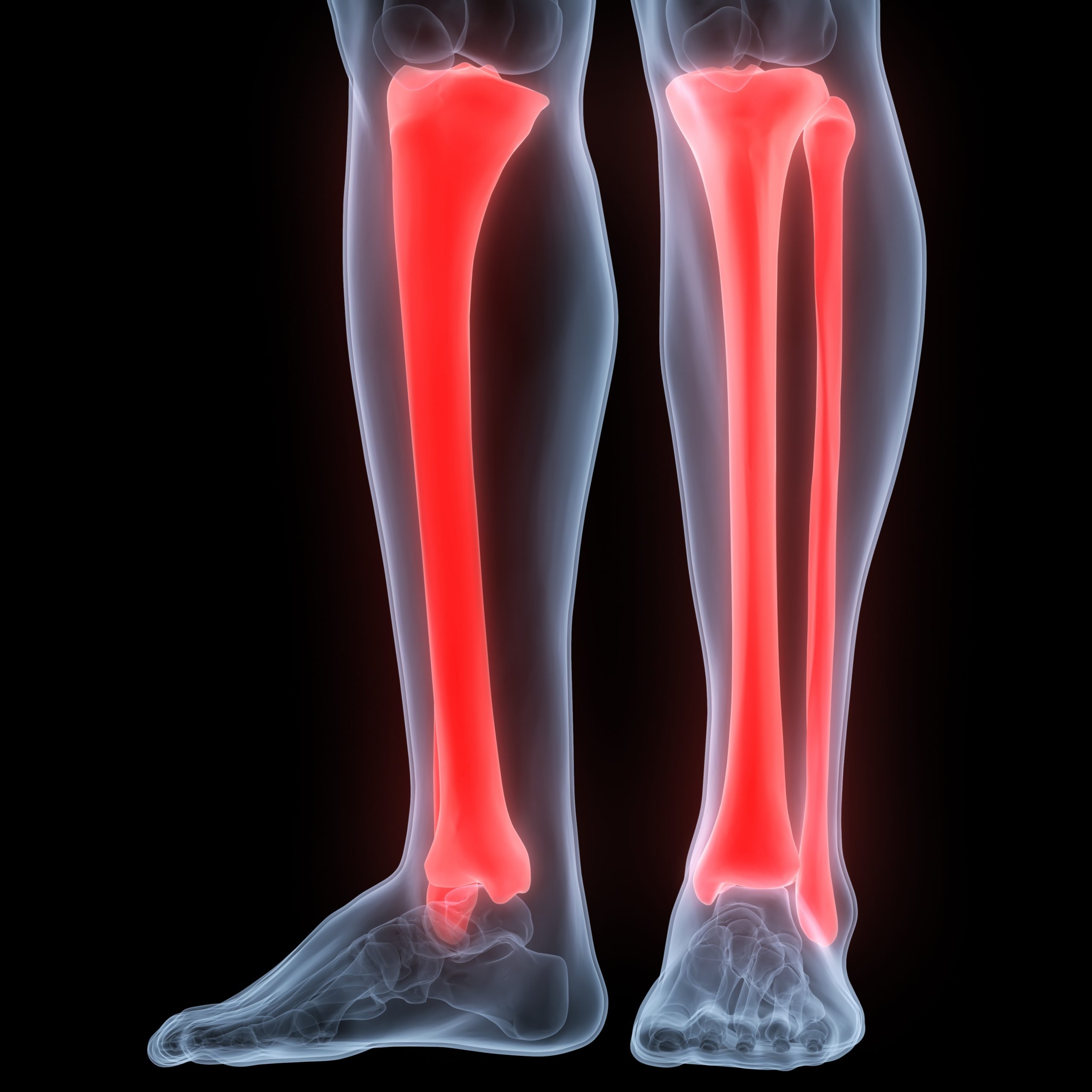 A tibia fracture after a car accident is a serious injury